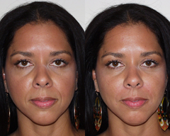 Chicago Clinic ha filler