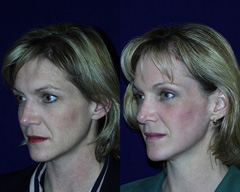 Chicago Clinic skin resurfacing